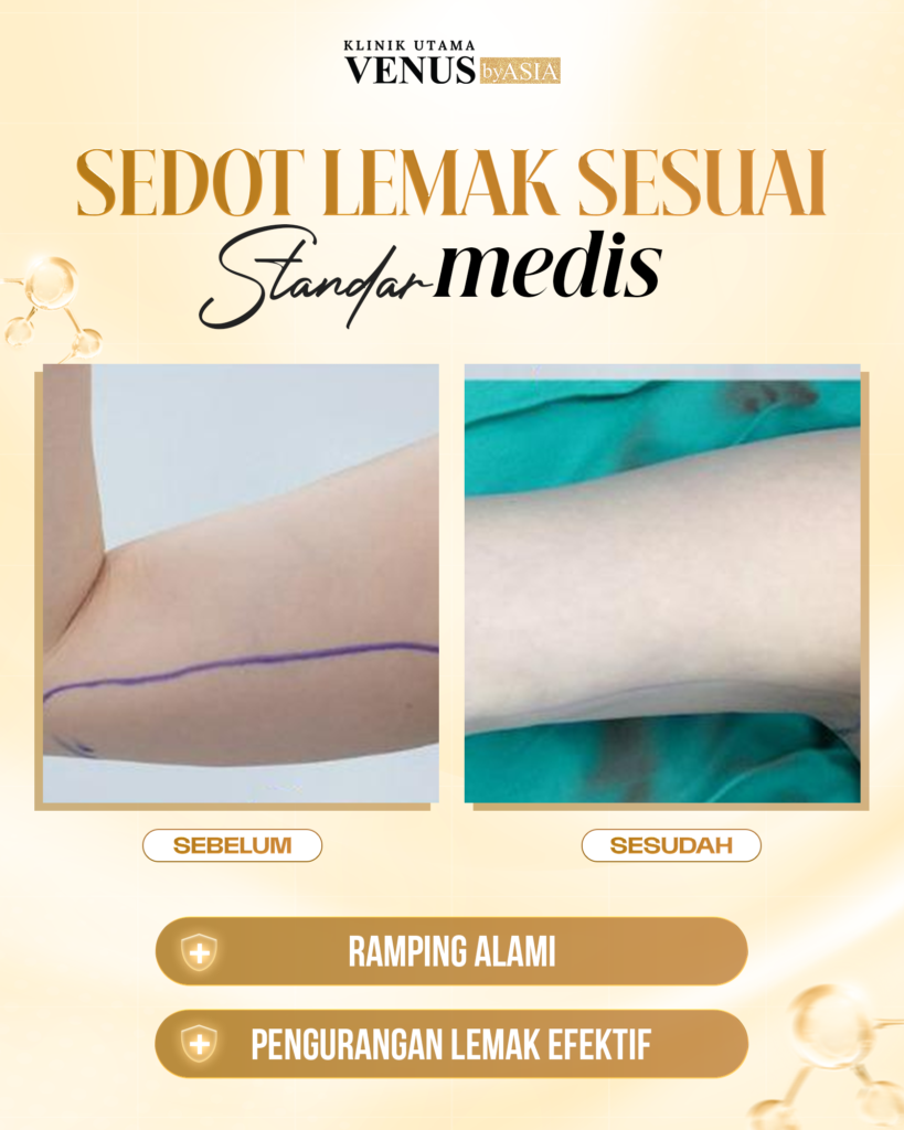 Lipo Suction
