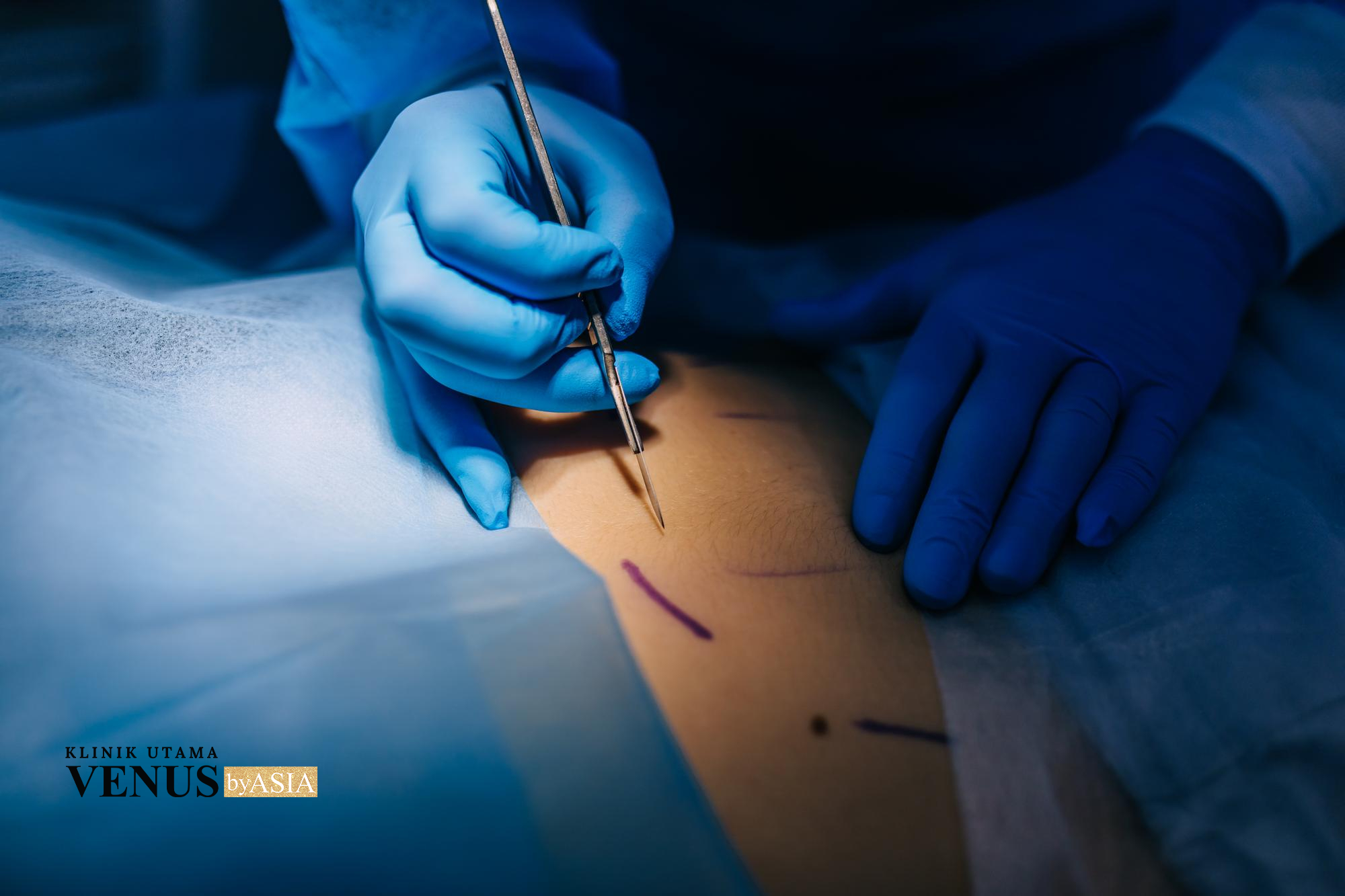 Lipo Suction