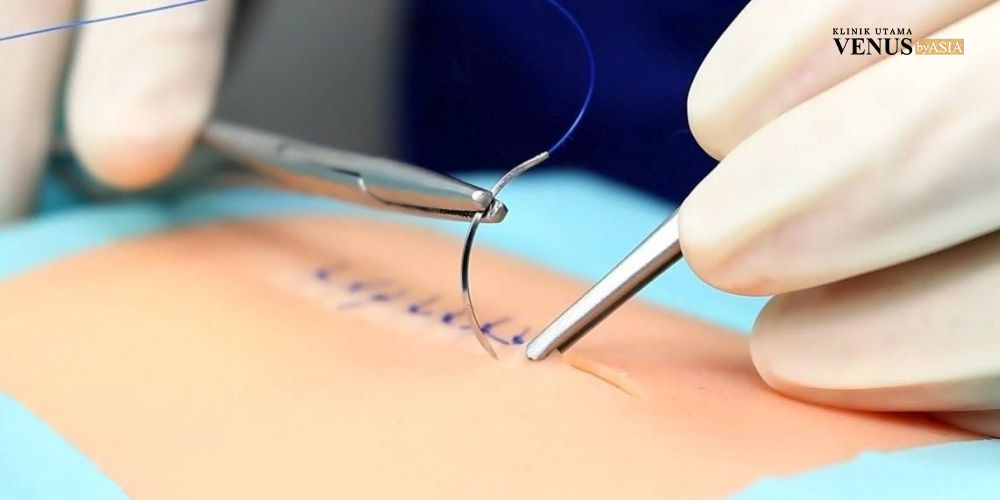 Lipo Suction