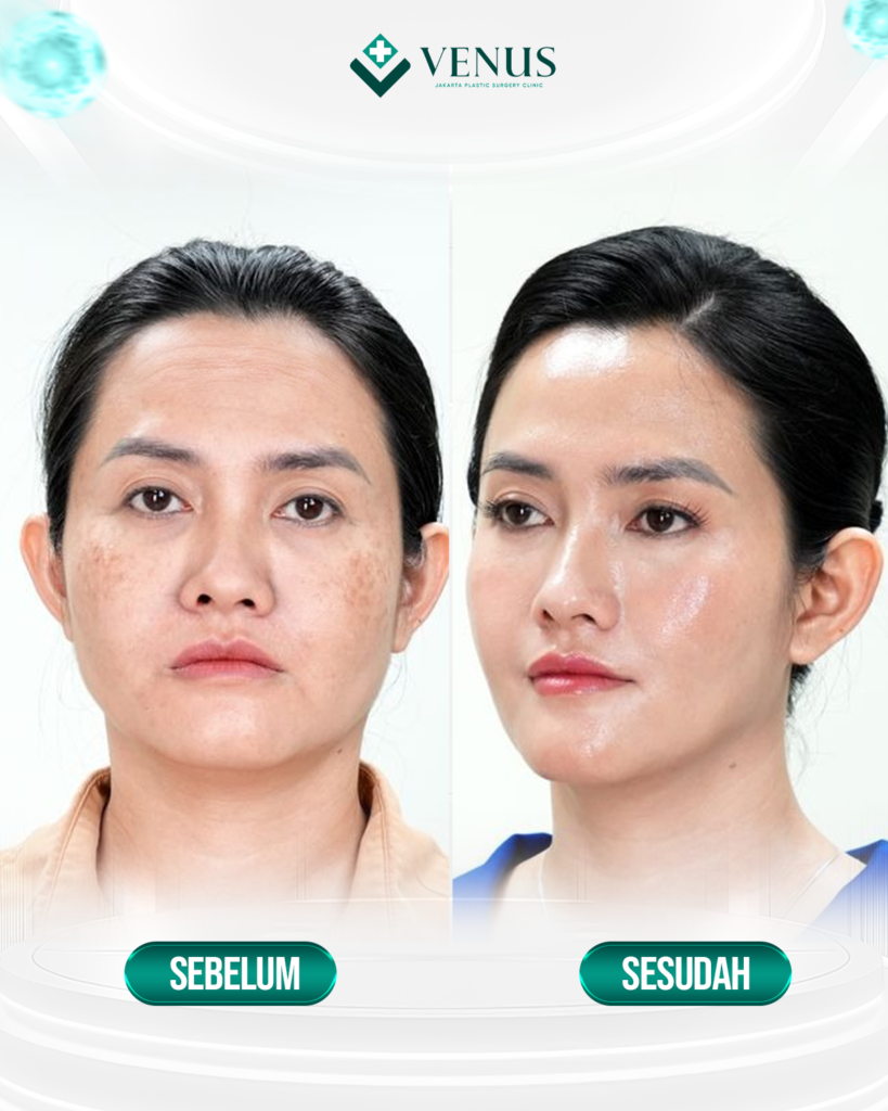 FOREHEAD LIFT