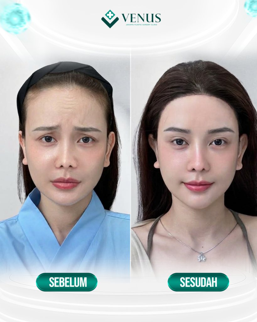 FOREHEAD LIFT