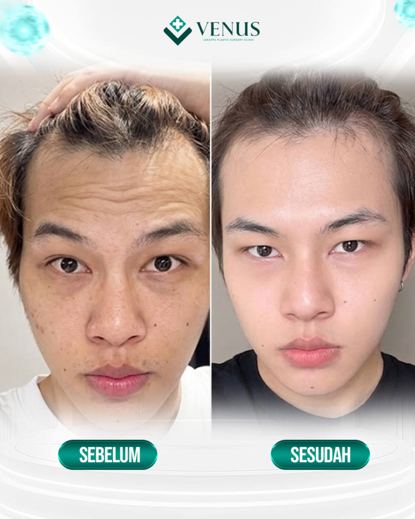 FOREHEAD LIFT