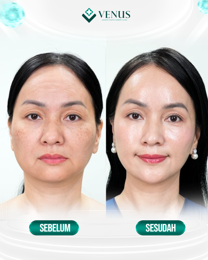FOREHEAD LIFT