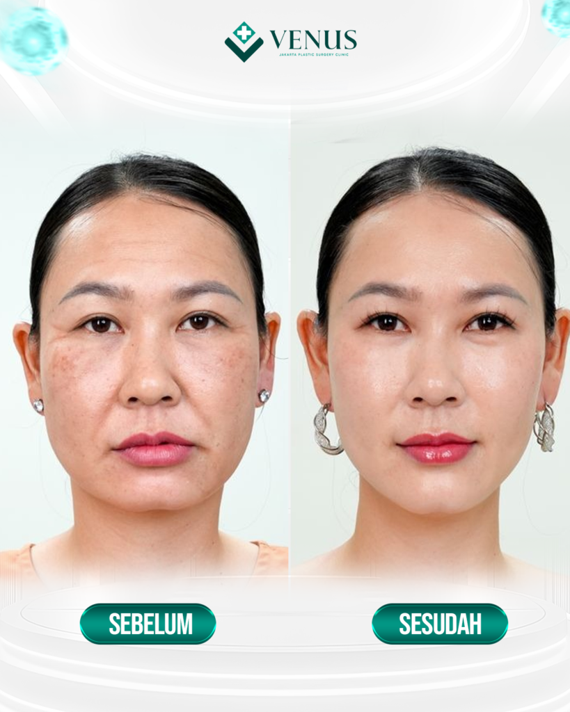 FOREHEAD LIFT