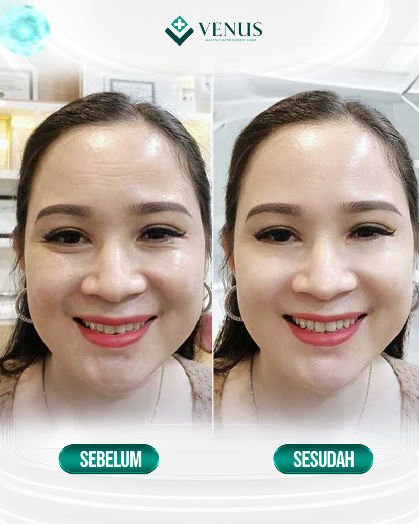 FOREHEAD LIFT