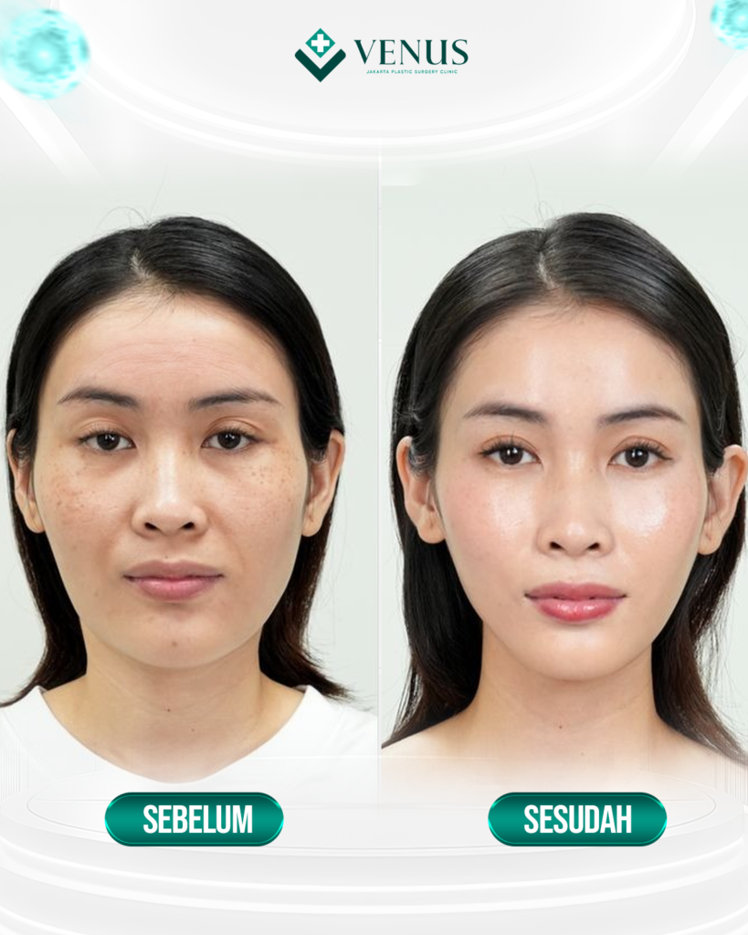 FOREHEAD LIFT